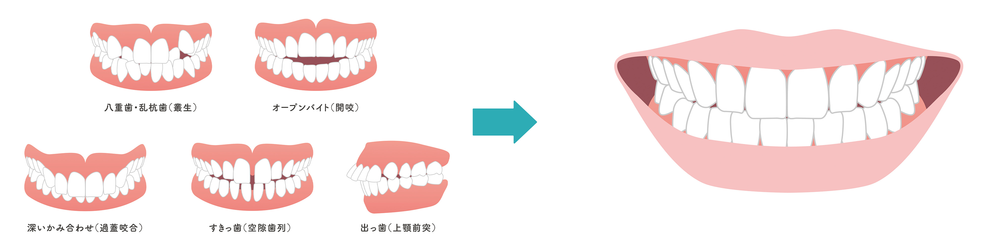 歯並びの乱れの例　出っ歯、すきっ歯など