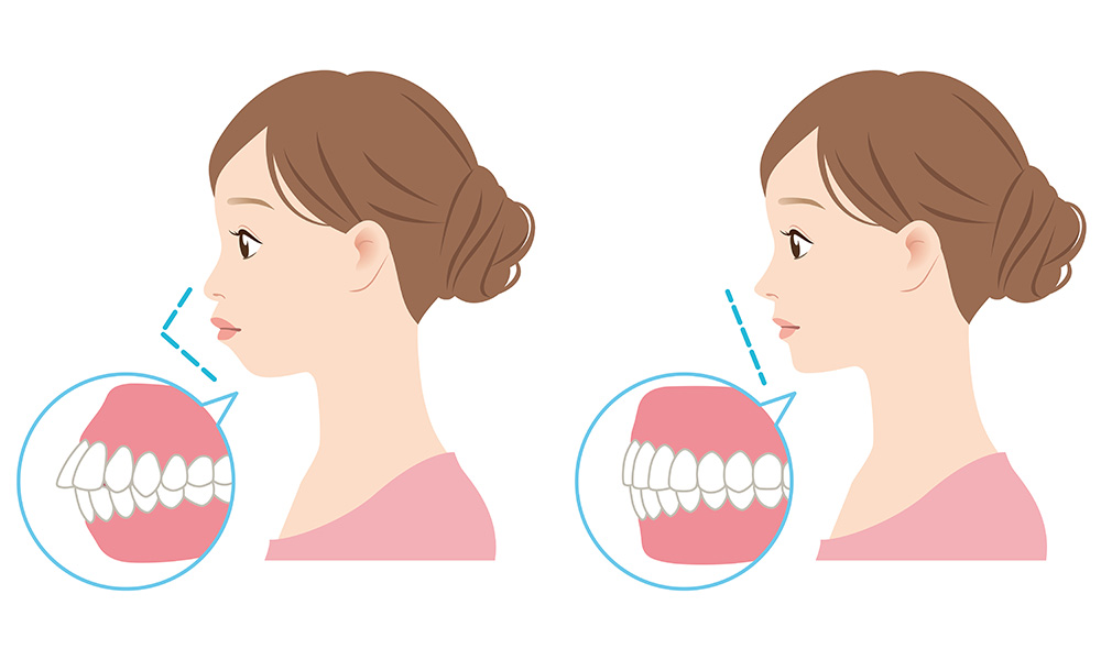 「口ゴボ」や「アデノイド顔貌」といわれるお口元