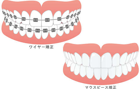 矯正器具が目立たない